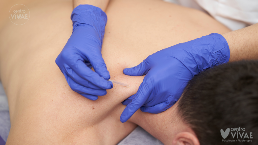 Aplicación de fisioterapia invasiva y punción secaen Fuengirola en Centro Vivae